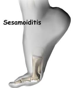 Causes and Signs of Sesamoiditis 1
