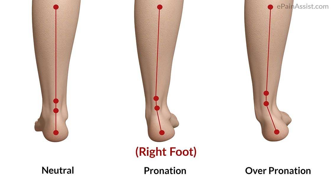 different types of foot pronation