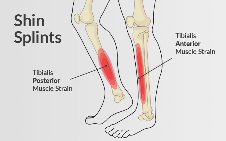 Reasons for Shin Splints