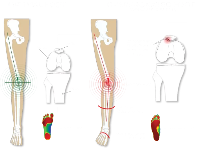 do insoles help with overpronation 1