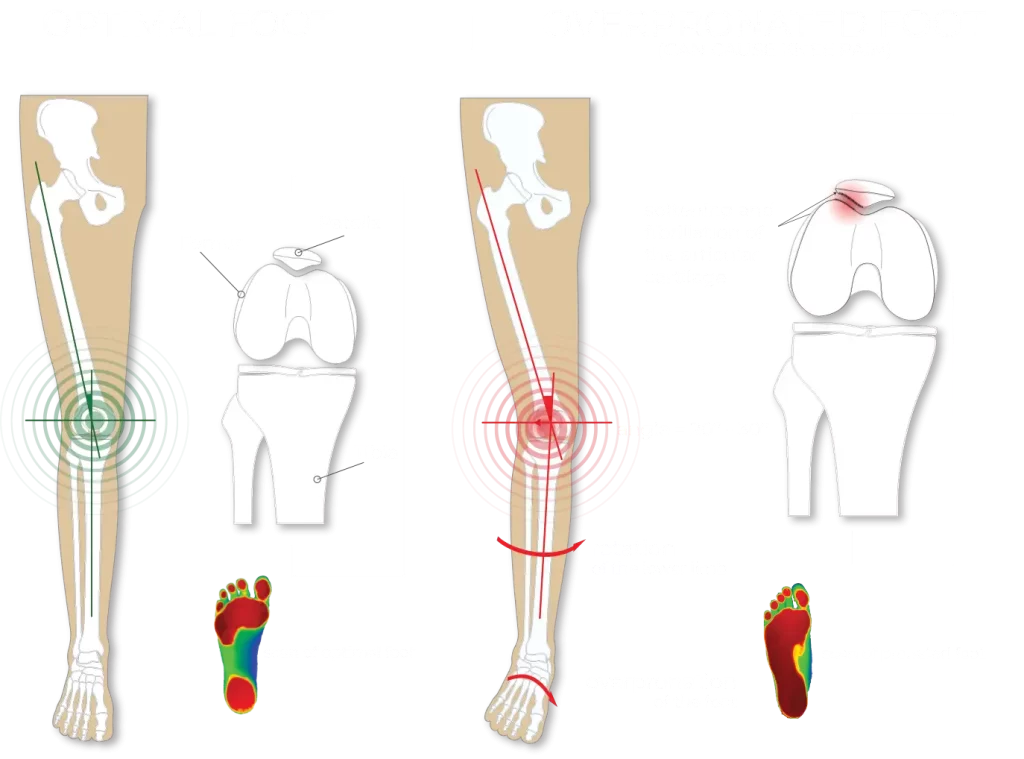 Do Insoles Help With Overpronation?