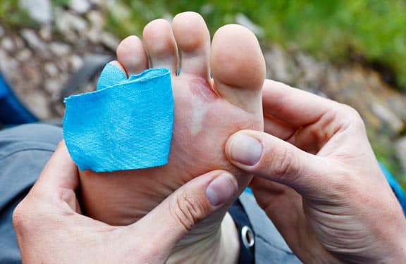 How Can I Prevent Blisters While Running?