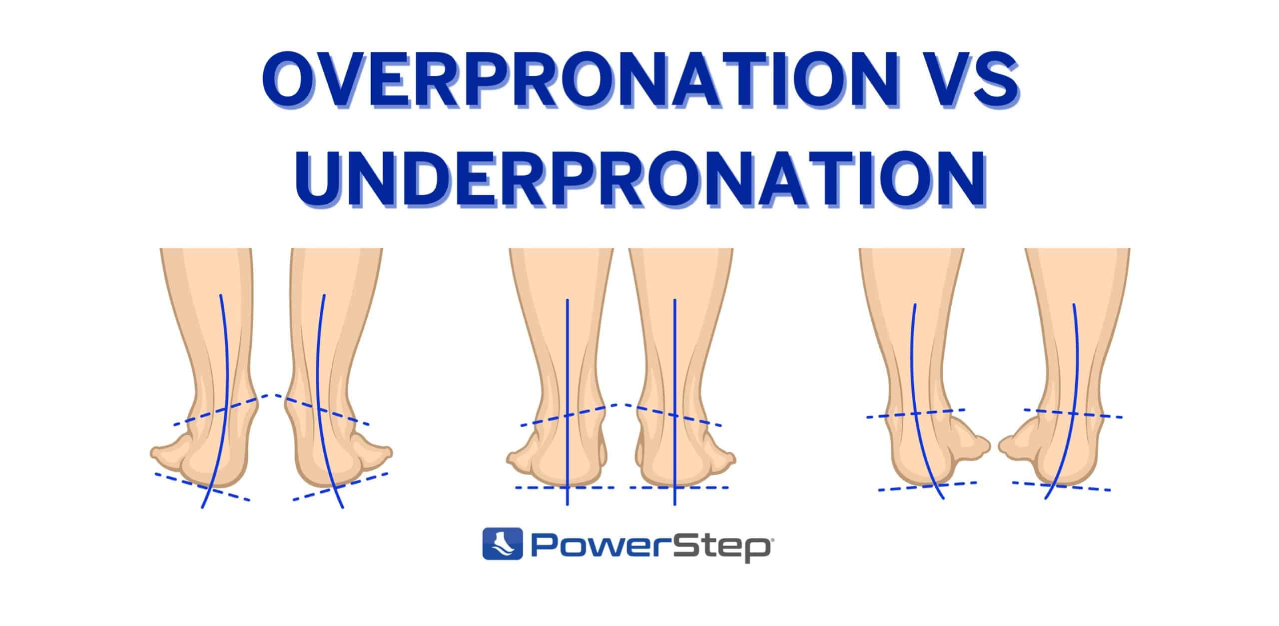 Can Insoles Help Correct Overpronation Or Supination?