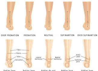 can insoles help correct overpronation or supination