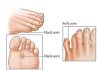 can insoles help prevent calluses and corns on the feet