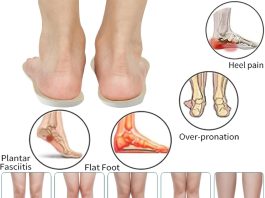 Different Heights Arch Support Insoles review