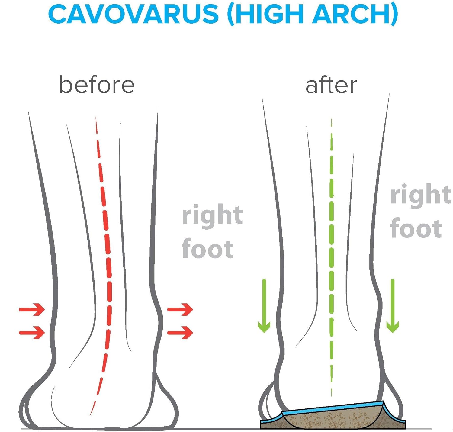 Arches Insoles Type - Supination/High Arch, Men’s Size 15-15.5 / Women’s Size 17-17.5 Arches Insoles Type - Supination/High Arch, Men’s Size 15-15.5 / Women’s Size 17-17.5