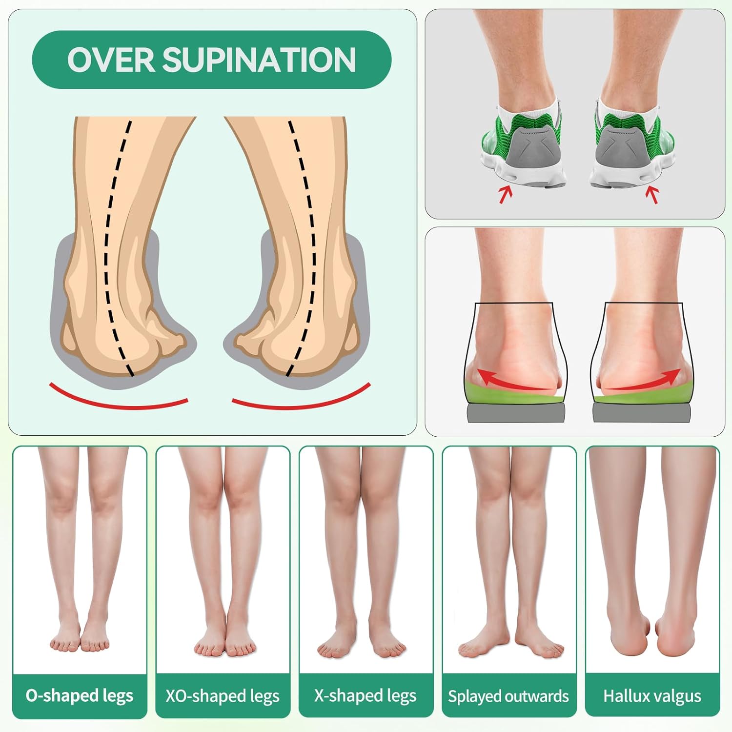 Supination Correction Insoles for Men and Women, O/XO Leg Orthopedic Corrective Insoles and Arch Support Comfort Cushion Inserts for Bow Legs, Foot Alignment, Posture Improve (M: M 8-9.5/W 9.5-11) Supination Correction Insoles for Men and Women, O/XO Leg Orthopedic Corrective Insoles and Arch Support Comfort Cushion Inserts for Bow Legs, Foot Alignment, Posture Improve (M: M 8-9.5/W 9.5-11)